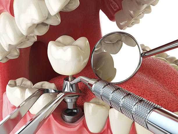 Best Emergency Dentist for Lost Fillings or Crowns in Walnut Park, CA